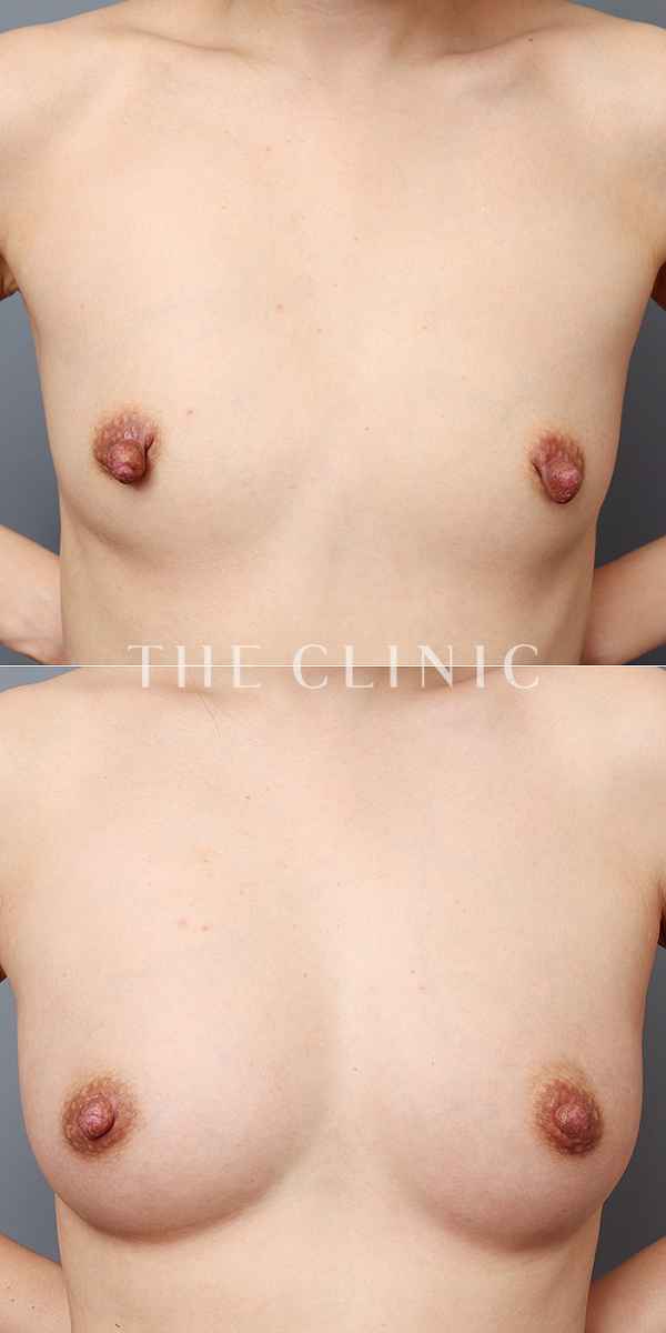 ボリュームアップの上向きバスト豊胸（40歳女性）の術前・術後写真