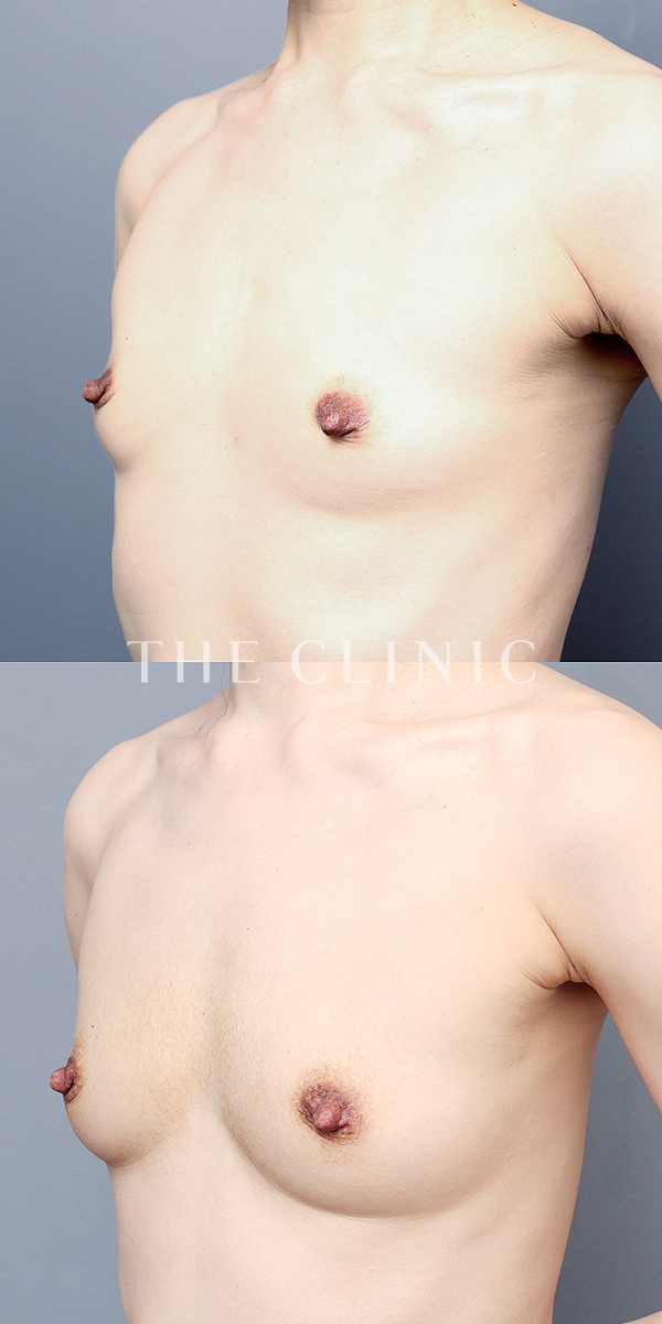 ボリュームアップの上向きバスト豊胸（51歳女性）の術前・術後写真