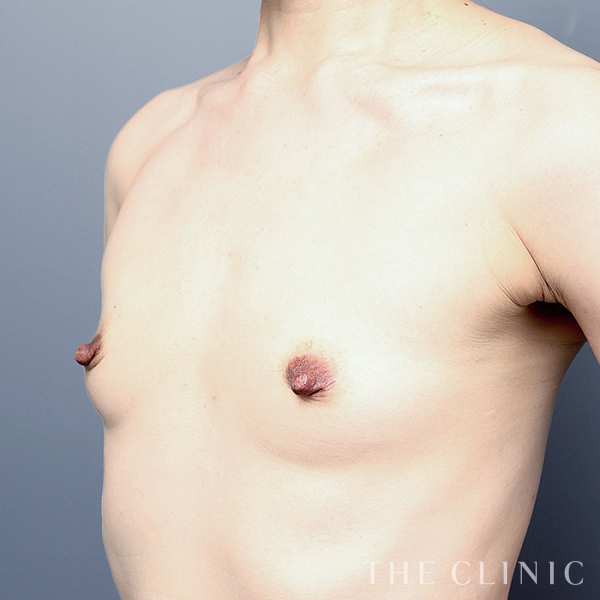 ボリュームアップの上向きバスト豊胸（51歳女性）の術前写真