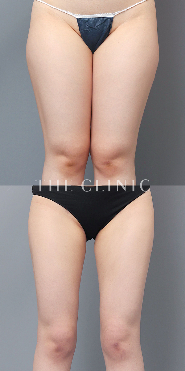 太もものベイザー脂肪吸引（23歳女性）の術前・術後写真