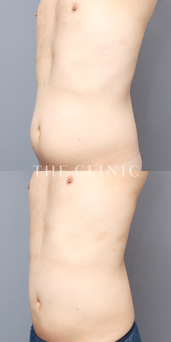 腹部のベイザー脂肪吸引（32歳男性）の術前・術後写真