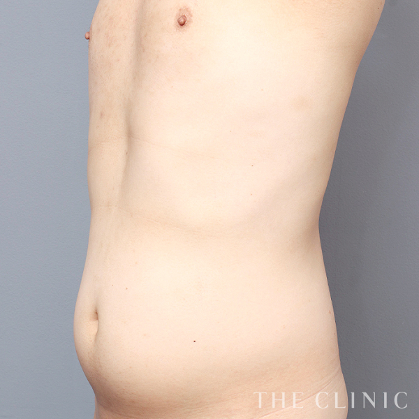 THE CLINIC ザクリニック　脂肪吸引　圧迫着　お腹背中腰S美品 THE CLINIC ザクリニック 脂肪吸引 圧迫着 お腹背中腰S美品 THE