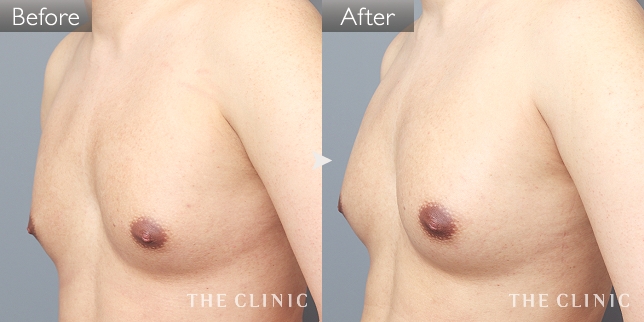 豊胸・胸の整形 ボリュームアップ 症例写真