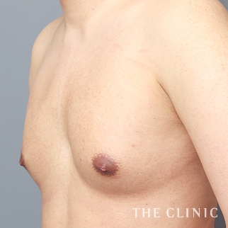 【THE CLINIC 症例画像】No.1317_1_ボリュームアップ_BRAVA×コンデンスリッチ豊胸(執刀医:)