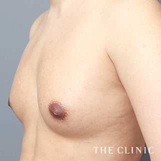 【THE CLINIC 症例画像】No.1317_2_ボリュームアップ_BRAVA×コンデンスリッチ豊胸(執刀医:)