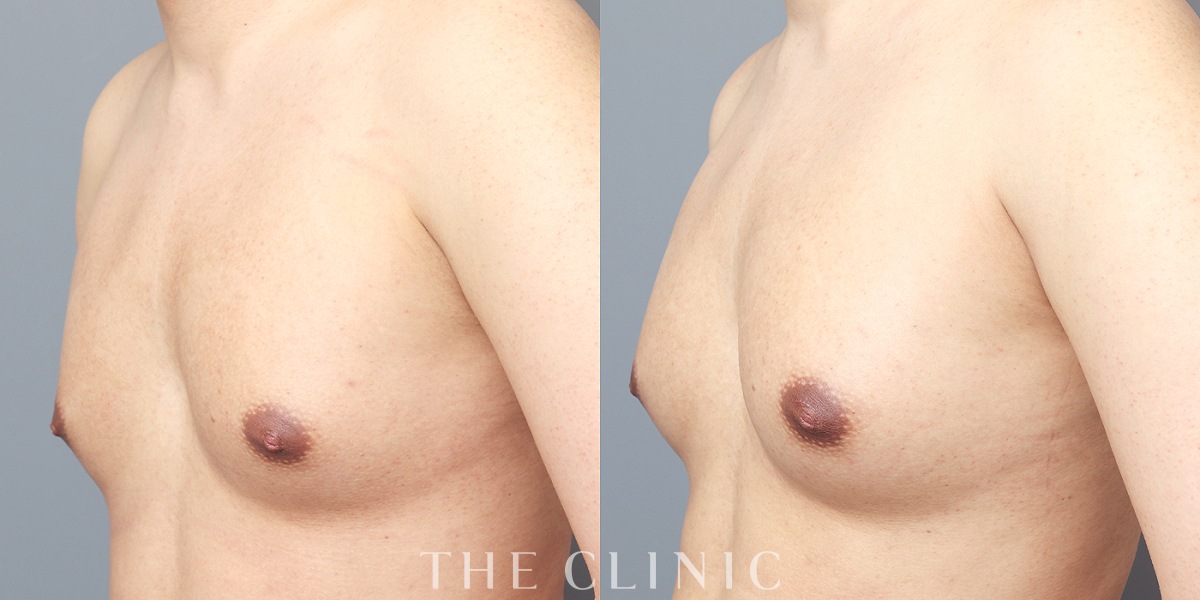 BRAVA×コンデンスリッチ豊胸の術前／術後