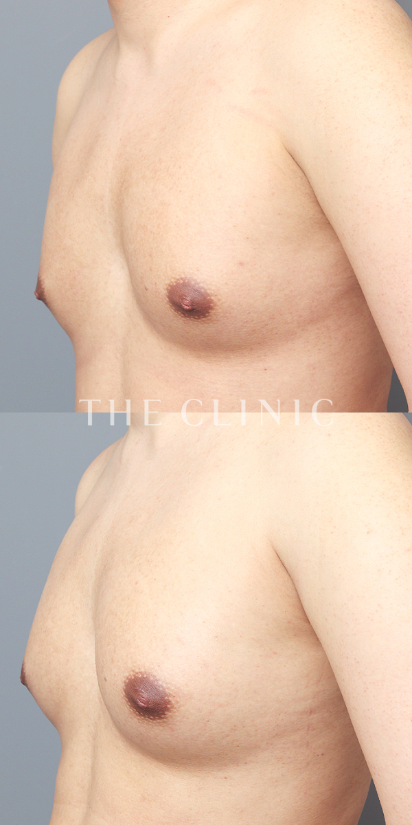 ボリュームアップのBRAVA×コンデンスリッチ豊胸（25歳男性）の術前・術後写真