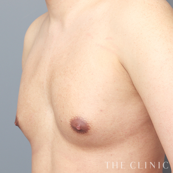 ボリュームアップのBRAVA×コンデンスリッチ豊胸（25歳男性）の術前写真