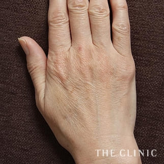 【THE CLINIC 症例画像】No.131_1_手のシワ_手の甲への脂肪注入(ハンドリバイブ)(執刀医:志田 雅明)