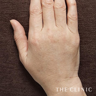 【THE CLINIC 症例画像】No.131_2_手のシワ_手の甲への脂肪注入(ハンドリバイブ)(執刀医:志田 雅明)
