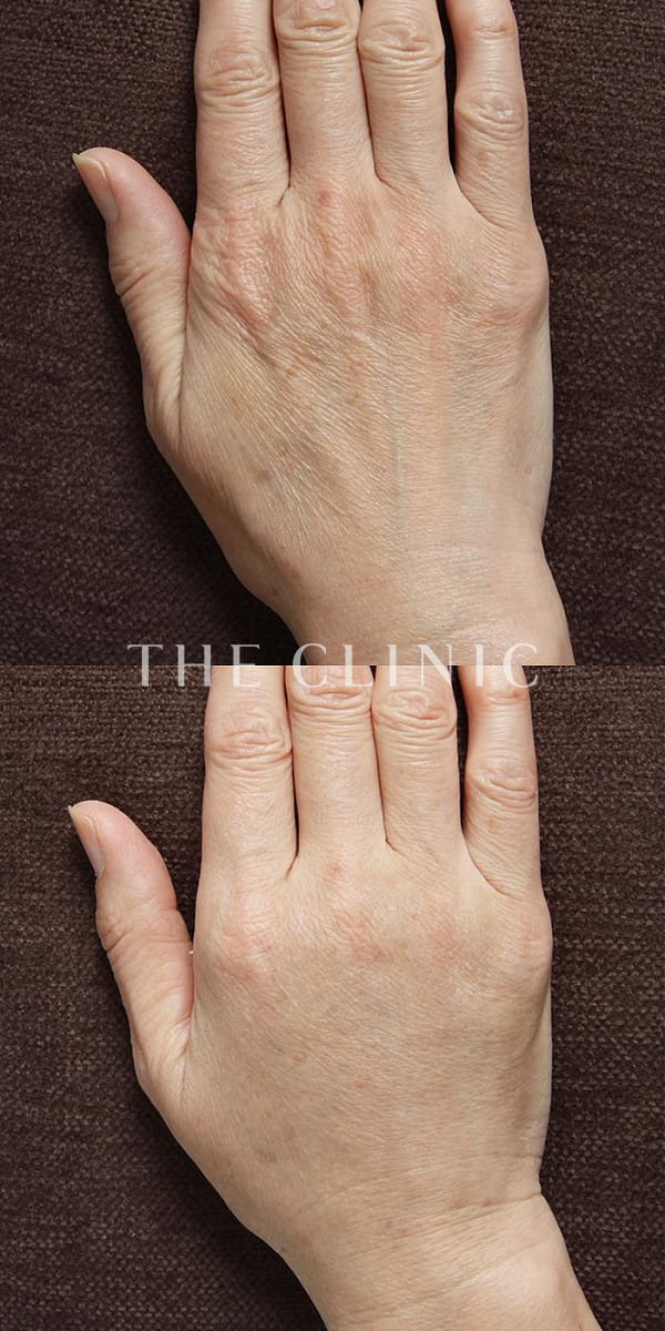 手のシワの手の甲への脂肪注入(ハンドリバイブ)（55歳女性）の術前・術後写真