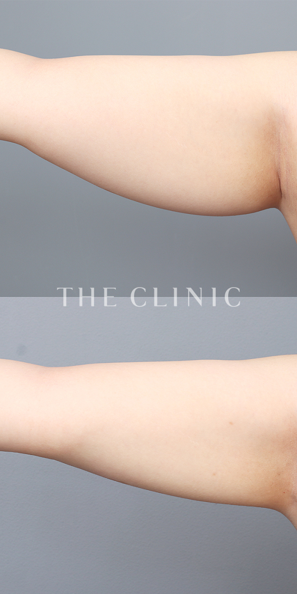 二の腕のベイザー脂肪吸引（24歳女性）の術前・術後写真