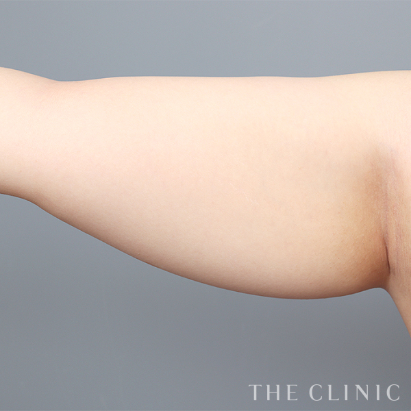 二の腕のベイザー脂肪吸引（24歳女性）の術前写真