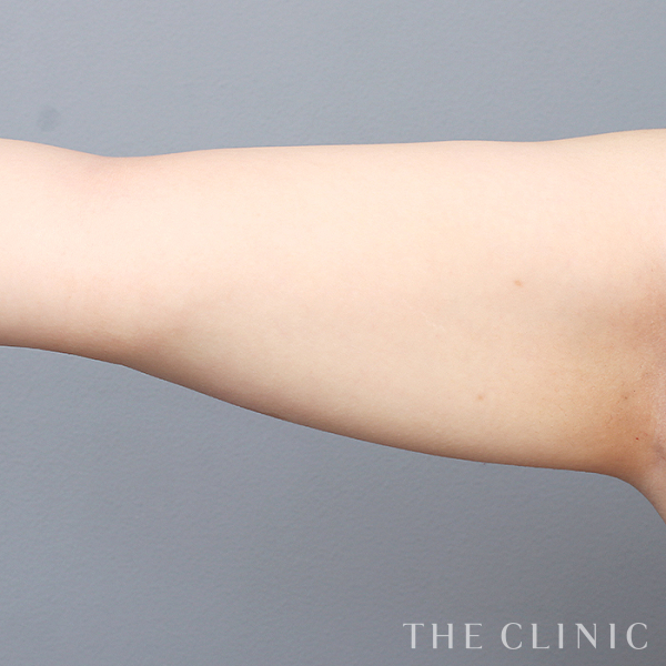 二の腕のベイザー脂肪吸引（24歳女性）の術後写真