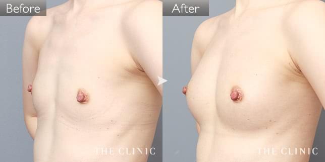 豊胸・胸の整形 ボリュームアップ 症例写真