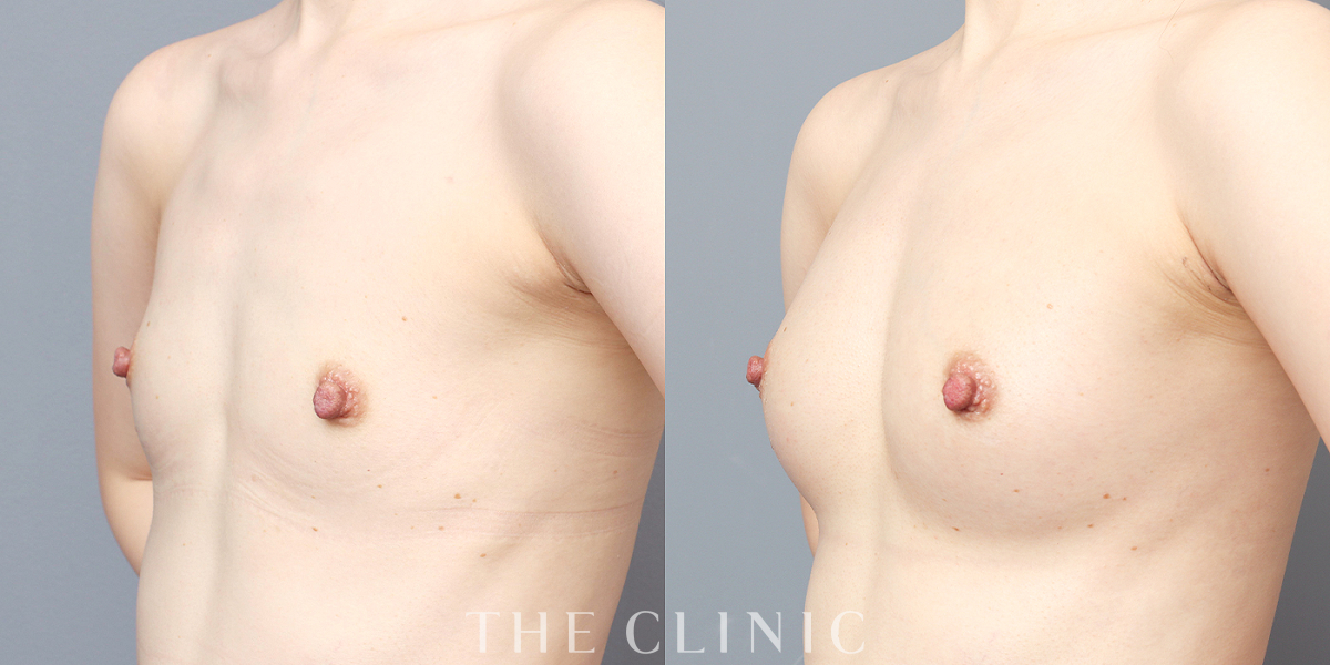 コンデンスビブラ豊胸の術前／術後