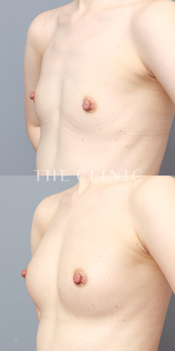 ボリュームアップのコンデンスビブラ豊胸（34歳女性）の術前・術後写真