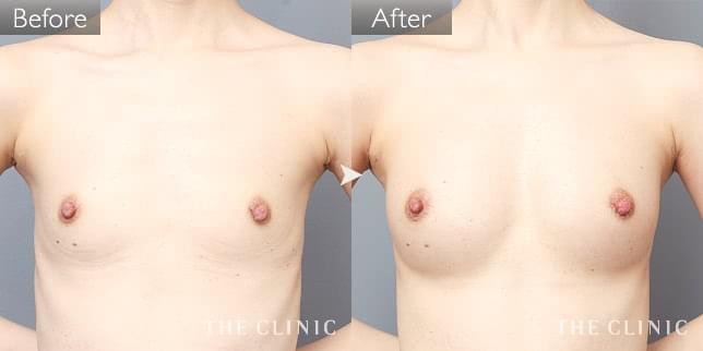 豊胸・胸の整形 ボリュームアップ 症例写真