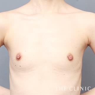 【THE CLINIC 症例画像】No.1326_1_ボリュームアップ_コンデンスビブラ豊胸(執刀医:帯包 雄次郎)