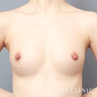 【THE CLINIC 症例画像】No.1326_2_ボリュームアップ_コンデンスビブラ豊胸(執刀医:帯包 雄次郎)