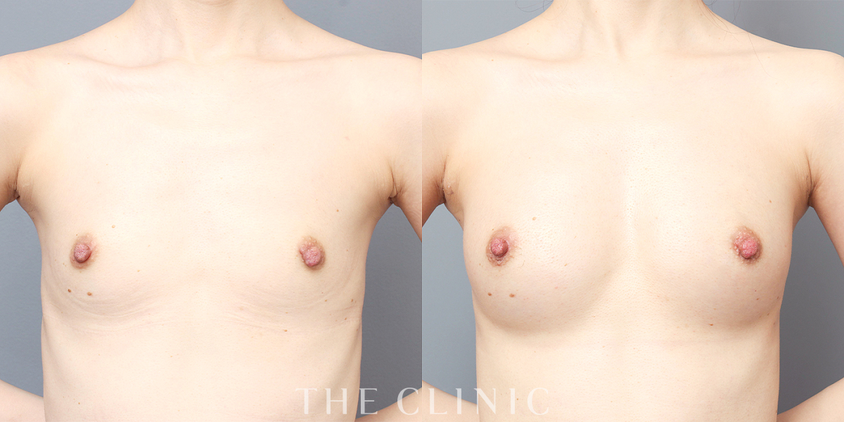 コンデンスビブラ豊胸の術前／術後