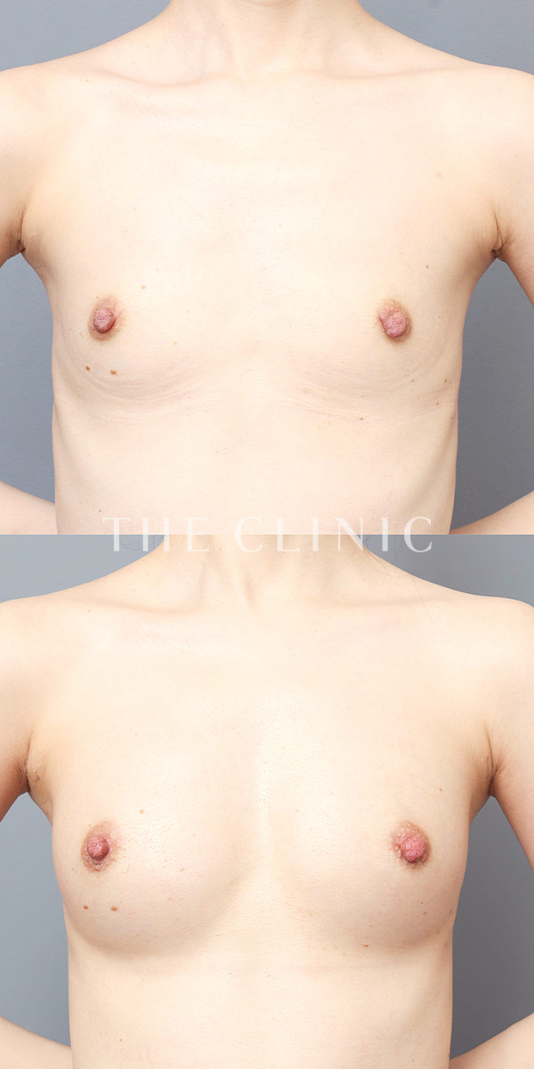 ボリュームアップのコンデンスビブラ豊胸（34歳女性）の術前・術後写真