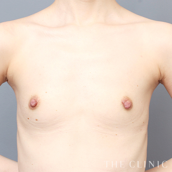 ボリュームアップのコンデンスビブラ豊胸（34歳女性）の術前写真