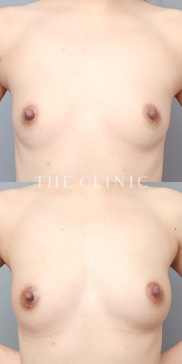 ボリュームアップのエクソソーム豊胸（30歳女性）の術前・術後写真