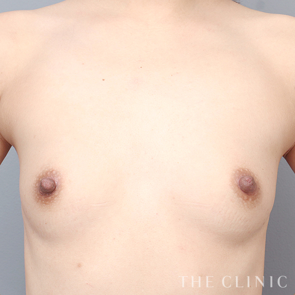 ボリュームアップのエクソソーム豊胸（30歳女性）の術前写真