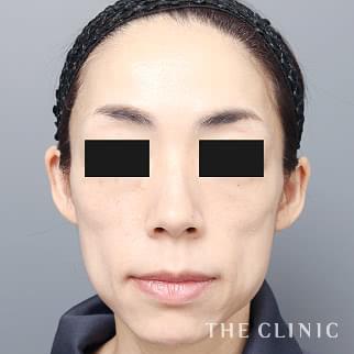 【THE CLINIC 症例画像】No.1330_1_ボリュームアップ_マイクロCRF注入(顔の脂肪注入)(執刀医：帯包 雄次郎)