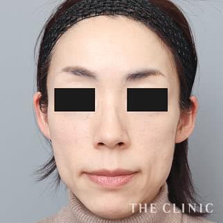 【THE CLINIC 症例画像】No.1330_2_ボリュームアップ_マイクロCRF注入(顔の脂肪注入)(執刀医:帯包 雄次郎)