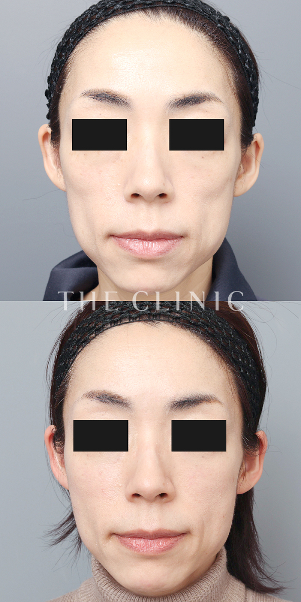 ボリュームアップ・こけた頬のマイクロCRF注入(顔の脂肪注入)（44歳女性）の術前・術後写真