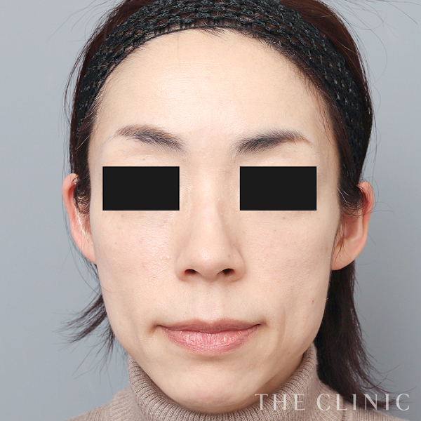 ボリュームアップ・こけた頬のマイクロCRF注入(顔の脂肪注入)（44歳女性）の術後写真