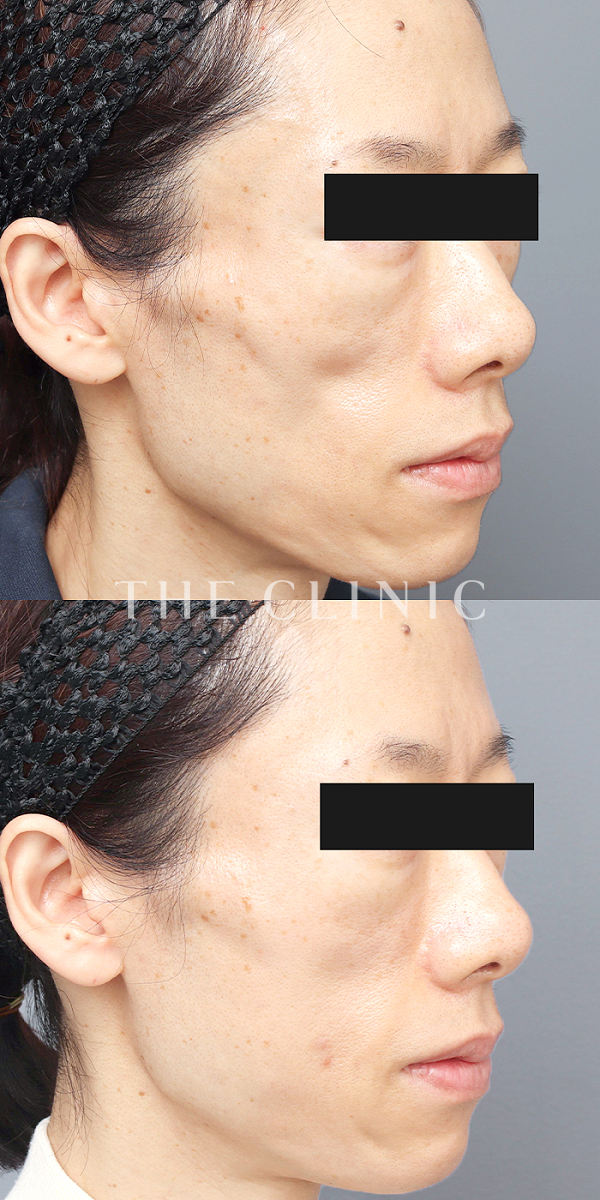 ボリュームアップ・こめかみ・こけた頬のコンデンスリッチフェイス(顔の脂肪注入)（43歳女性）の術前・術後写真