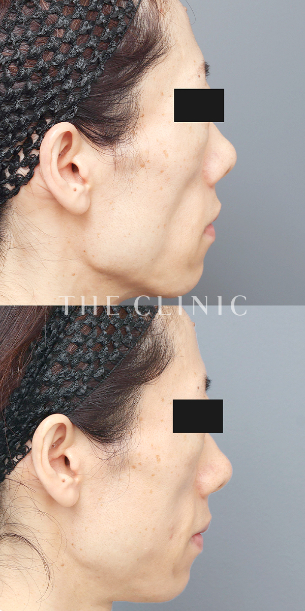 ボリュームアップ・こめかみ・こけた頬のコンデンスリッチフェイス(顔の脂肪注入)（43歳女性）の術前・術後写真