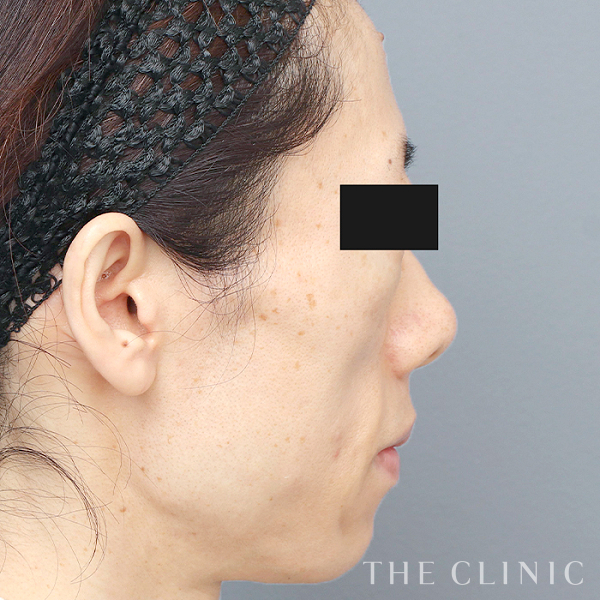 ボリュームアップ・こめかみ・こけた頬のコンデンスリッチフェイス(顔の脂肪注入)（43歳女性）の術後写真