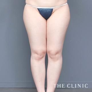 【THE CLINIC 症例画像】No.1340_1_太もも_ベイザー脂肪吸引(執刀医:安部 光洋)