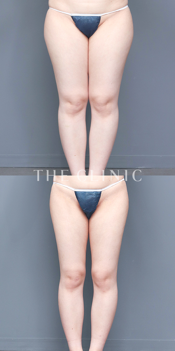 太もも・ふくらはぎ・足首のベイザー脂肪吸引（26歳女性）の術前・術後写真