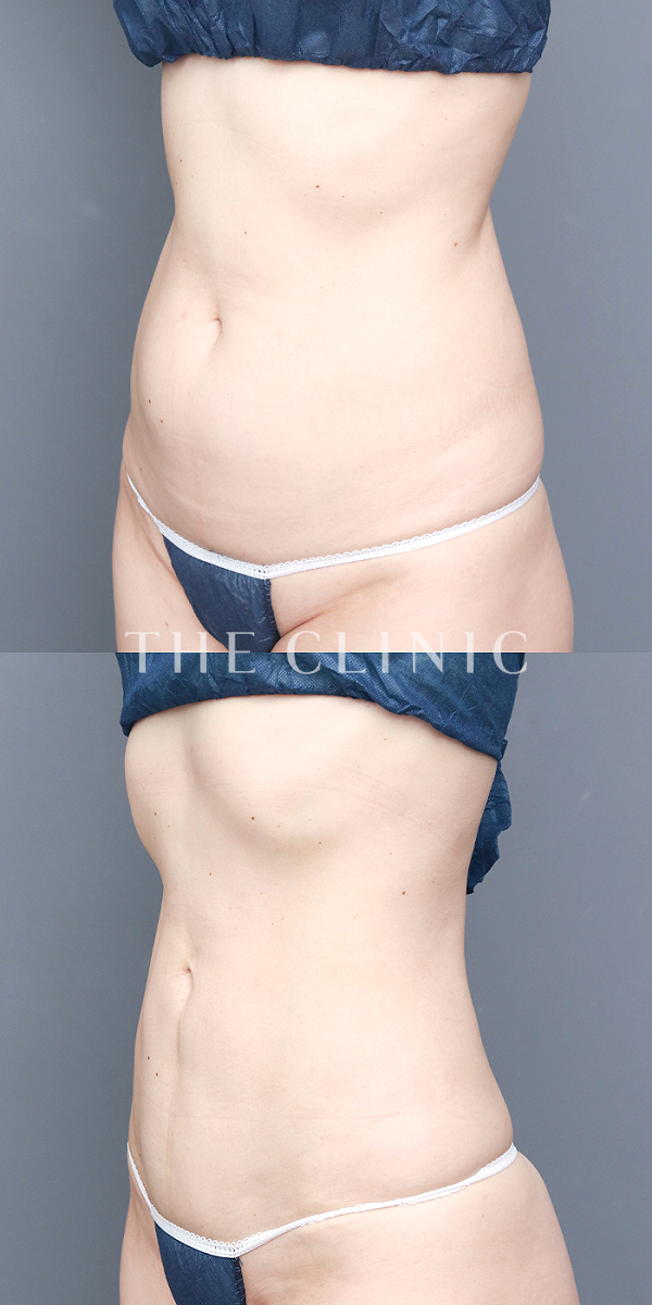 腹部・腰・ウエストのベイザー脂肪吸引（50歳女性）の術前・術後写真