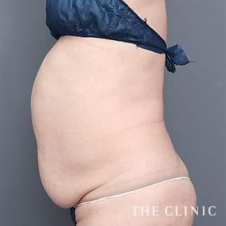 腹部／腰・ウエストのベイザー脂肪吸引のモニター（50代）術前症例画像