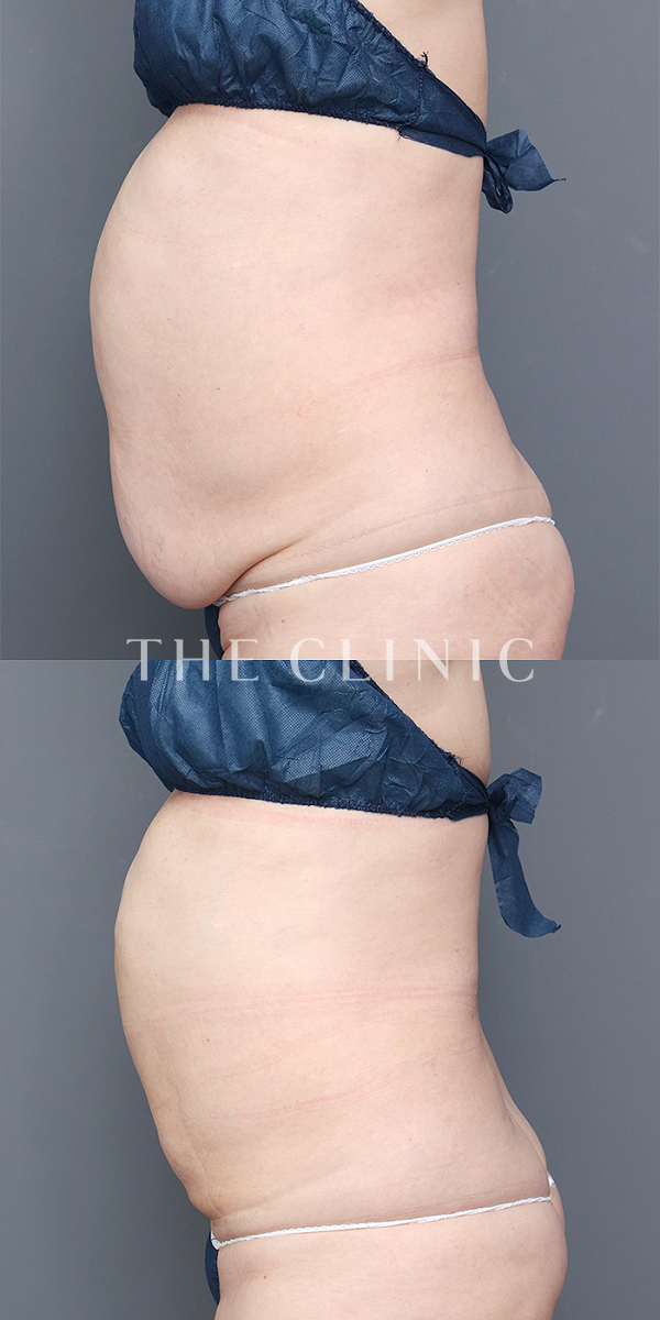 腹部・腰・ウエストのベイザー脂肪吸引（53歳女性）の術前・術後写真