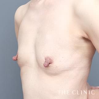 【THE CLINIC 症例画像】No.1345_1_ボリュームアップ_エクソソーム豊胸(執刀医:安部 光洋)