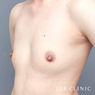 【THE CLINIC 症例画像】No.1346_1_ボリュームアップ_エクソソーム豊胸(執刀医:安部 光洋)