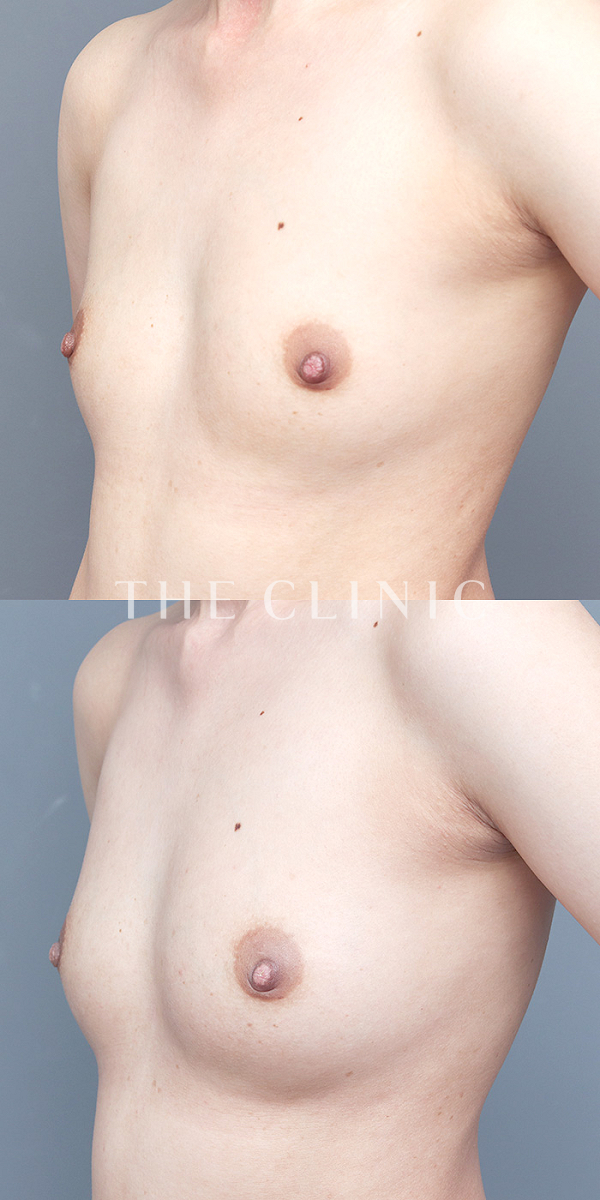 ボリュームアップ・左右のバランスのエクソソーム豊胸（32歳女性）の術前・術後写真