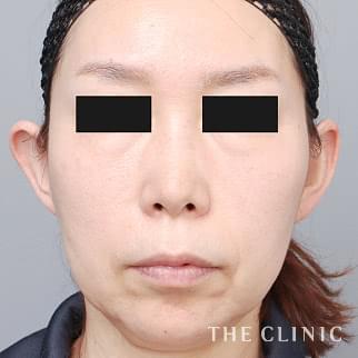 【THE CLINIC 症例画像】No.1347_1_頰/顎_360脂肪吸引®(執刀医:村田 八千穂)