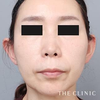 【THE CLINIC 症例画像】No.1347_2_頰/顎_360脂肪吸引®(執刀医:村田 八千穂)