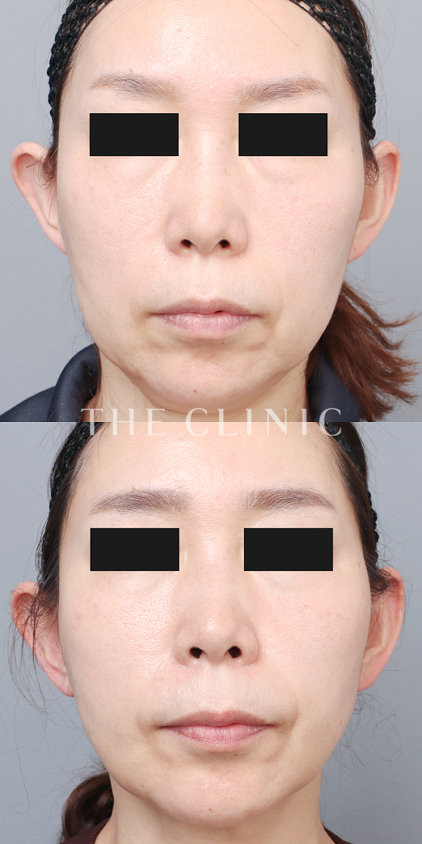 頰／顎のベイザー脂肪吸引（53歳女性）の術前・術後写真