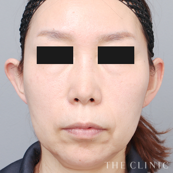 頰／顎のベイザー脂肪吸引（53歳女性）の術前写真