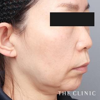頰／顎のベイザー脂肪吸引のモニター（50代）術前症例画像