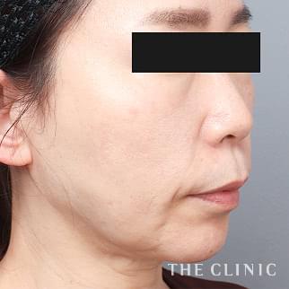 【THE CLINIC 症例画像】No.1348_2_頰/顎_360脂肪吸引®(執刀医:村田 八千穂)